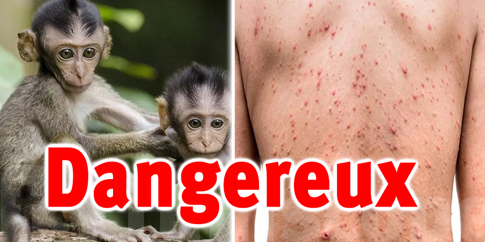 En photos : A quoi ressemblent les boutons de la variole du singe ?